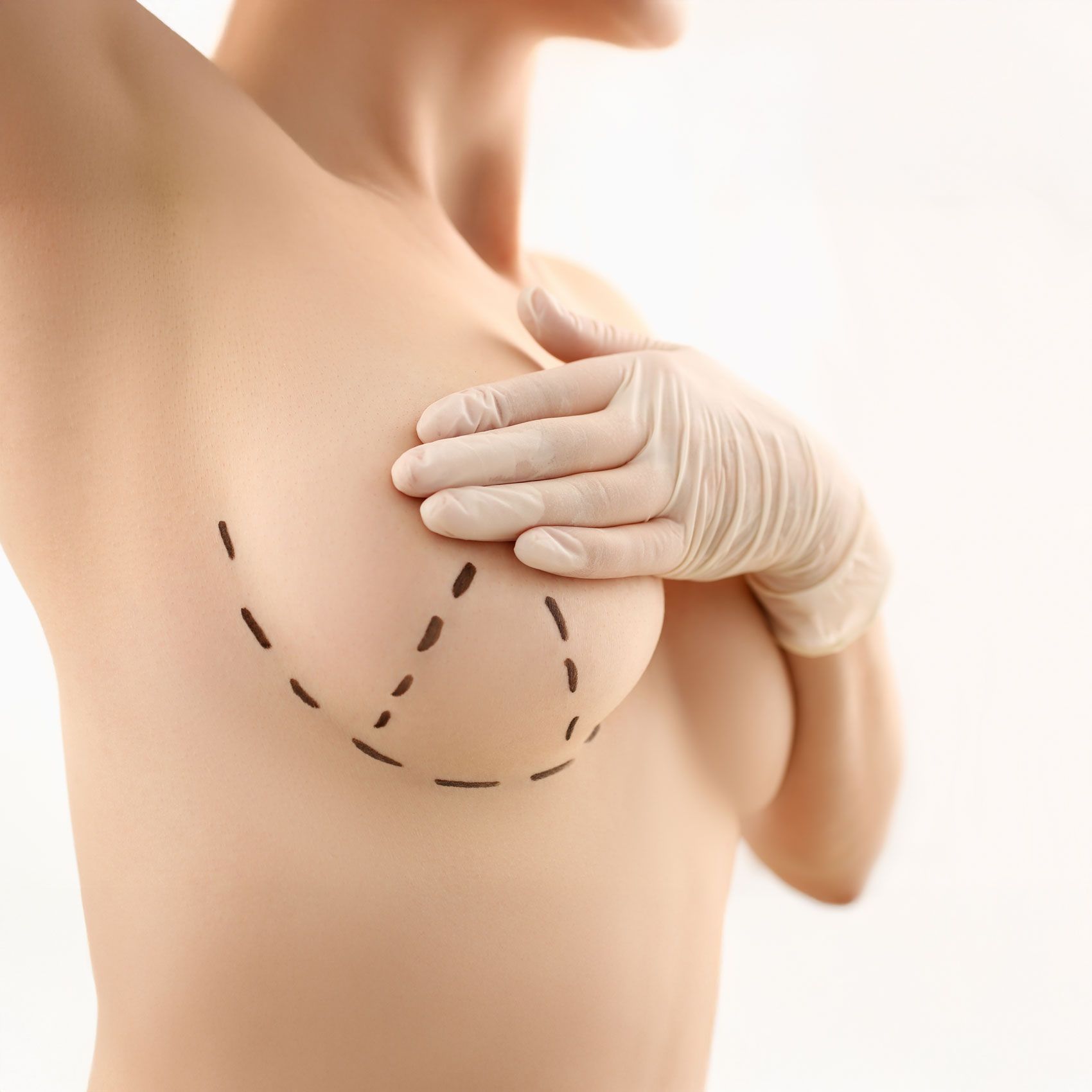 Breast Lift - Body Sculpt California