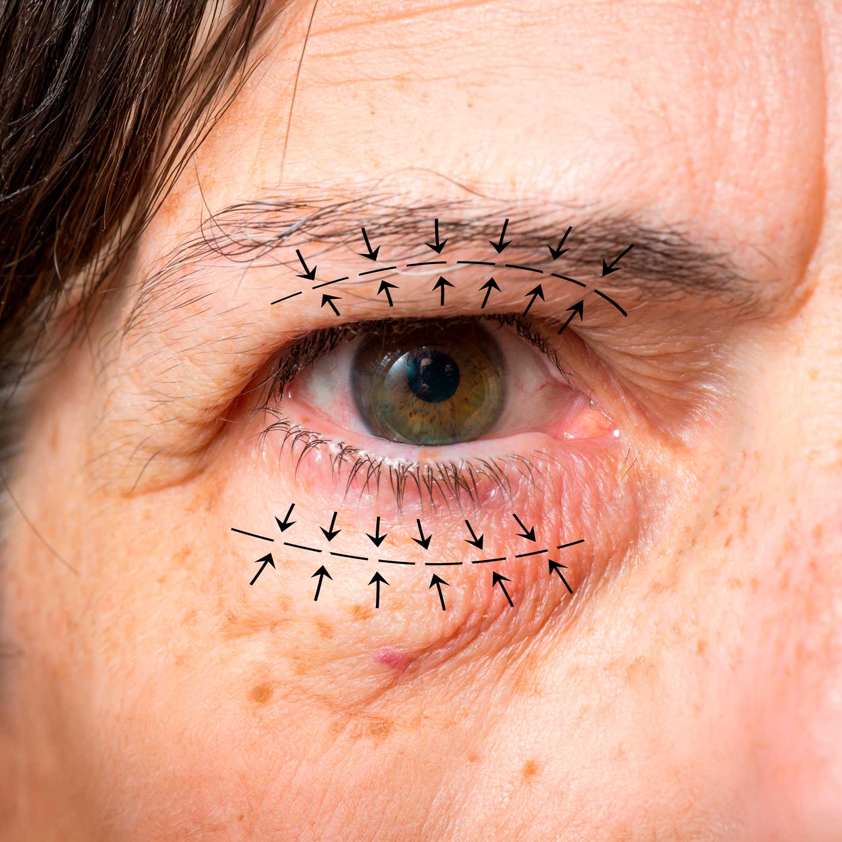 Blepharoplasty - Body Sculpt California