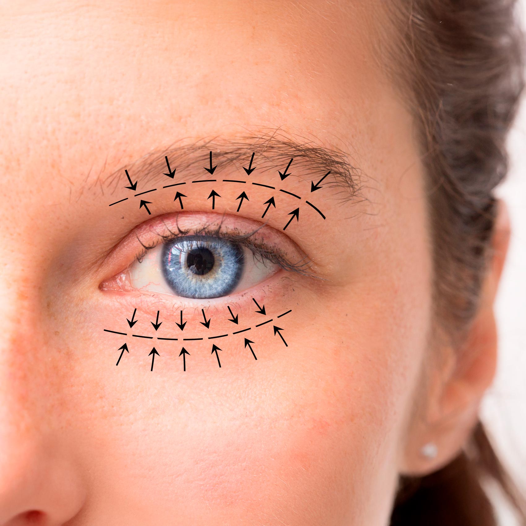 Blepharoplasty - Body Sculpt California
