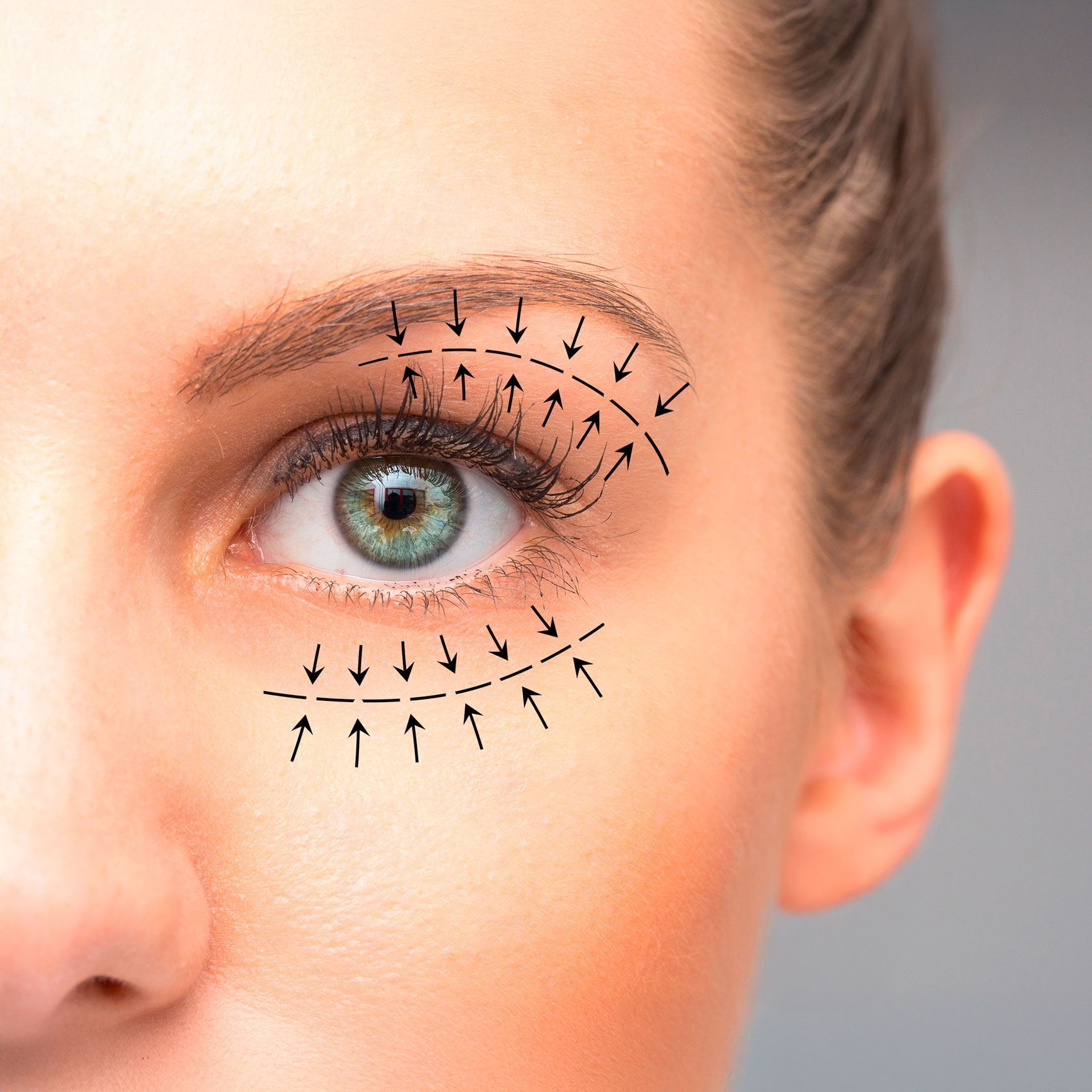 Blepharoplasty - Body Sculpt California